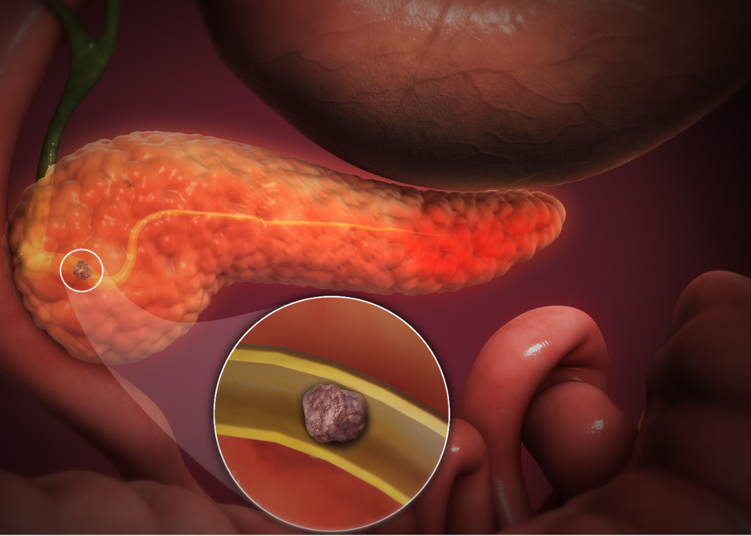 Pancreatitis Medical Illustration